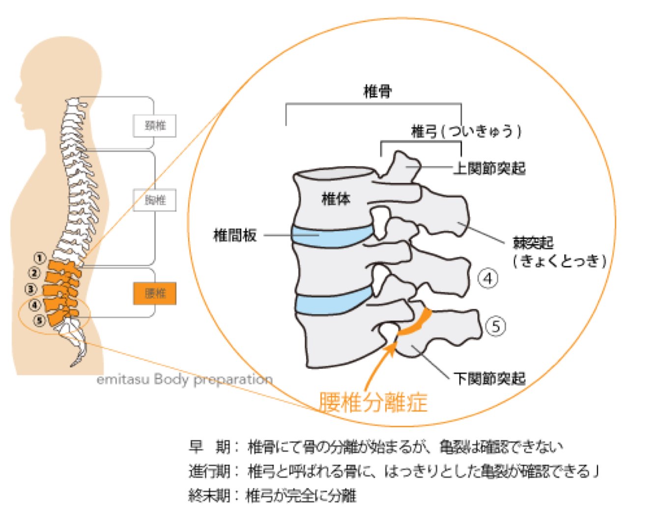 学生多い腰痛 腰椎分離症 19 07 30 かまた鍼灸整骨院 福島市 整体 スポーツ障害 鍼治療 酸素カプセル